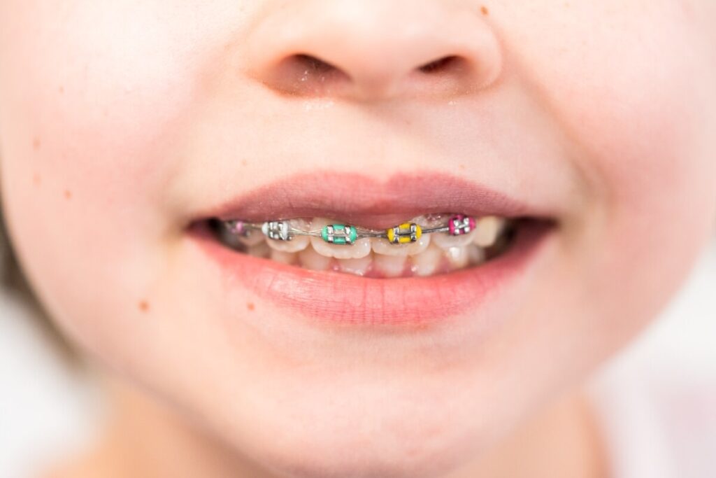 Zdjęcie dziecka z aparatem ortodontycznym, który jest jedną z popularnych metod leczenia wad zgryzu u dzieci.